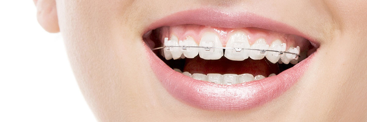 Gaithersburg  Invisible Orthodontics