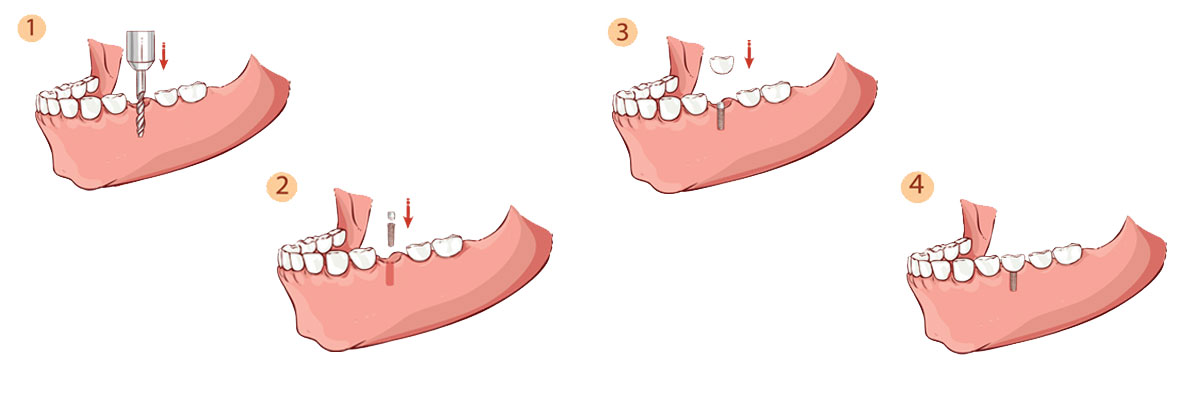 Gaithersburg  The Dental Implant Procedure