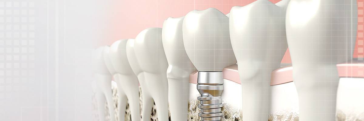 Gaithersburg  Dental Prosthetics