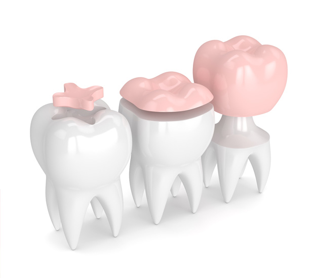 Gaithersburg Dental Inlays and Onlays