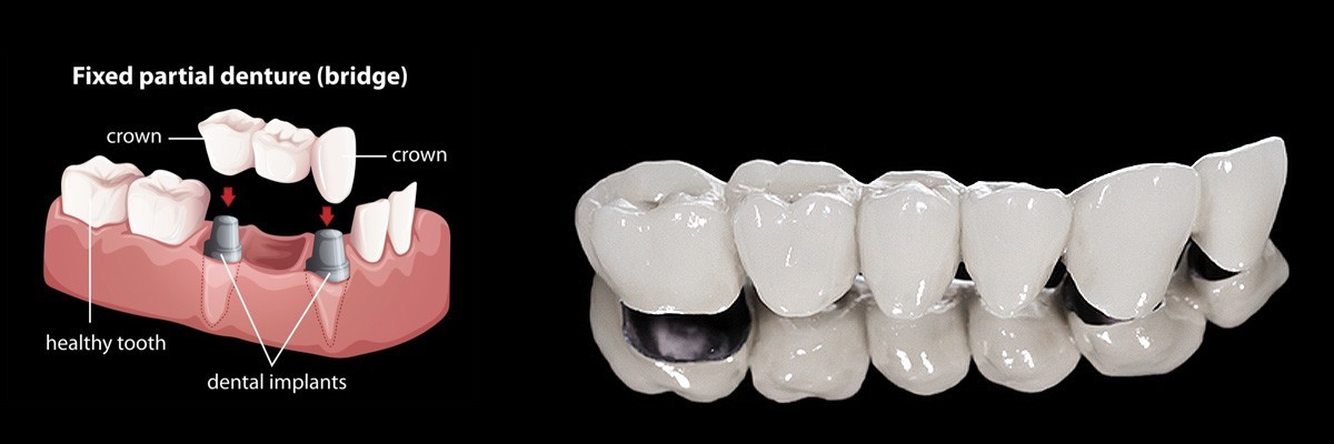 Gaithersburg  Dentures