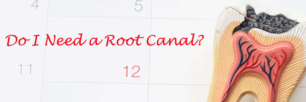 Gaithersburg  Do I Need a Root Canal