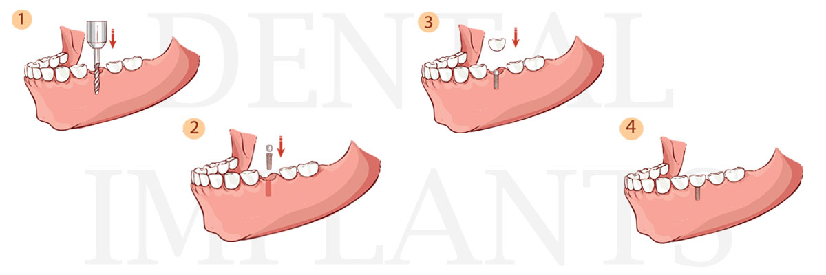 Gaithersburg  The Difference Between Dental Implants and Mini Dental Implants