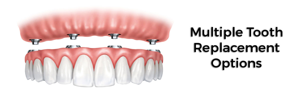 Gaithersburg  Multiple Teeth Replacement Options