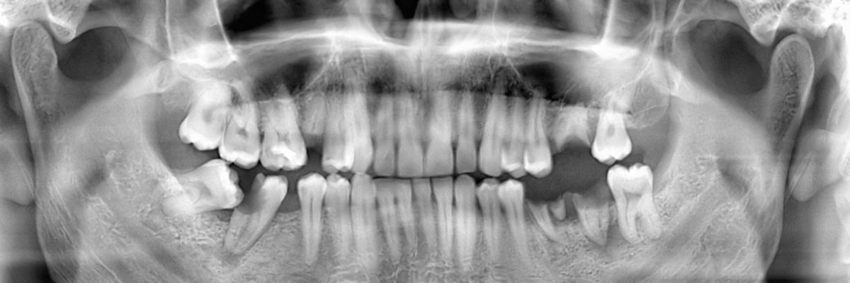 Gaithersburg  Options for Replacing Missing Teeth