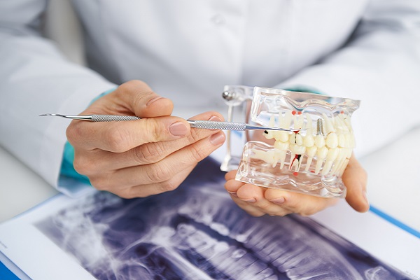 Do I Need A Referral For Endodontic Treatment?