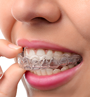 Clear Aligners - Almost Invisible Braces Gaithersburg , MD