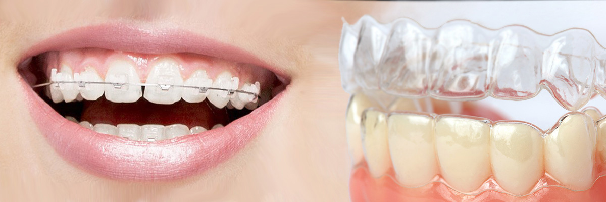 Gaithersburg  Which is Better Invisalign or Braces
